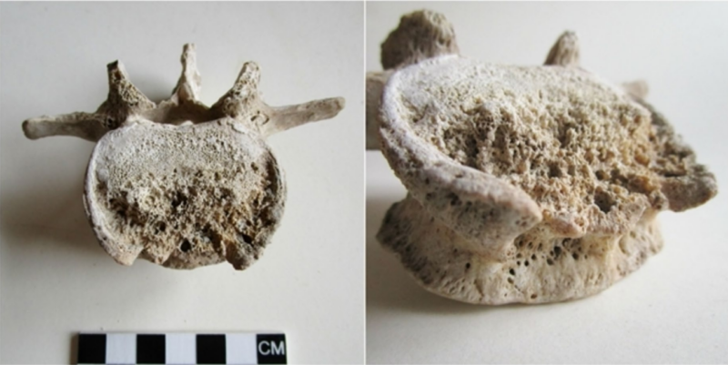 Pompeii victim had spinal tuberculosis when he died