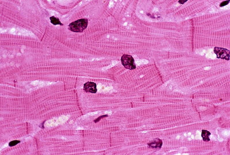 Pig heart transplant failure: Doctors detail everything that went wrong