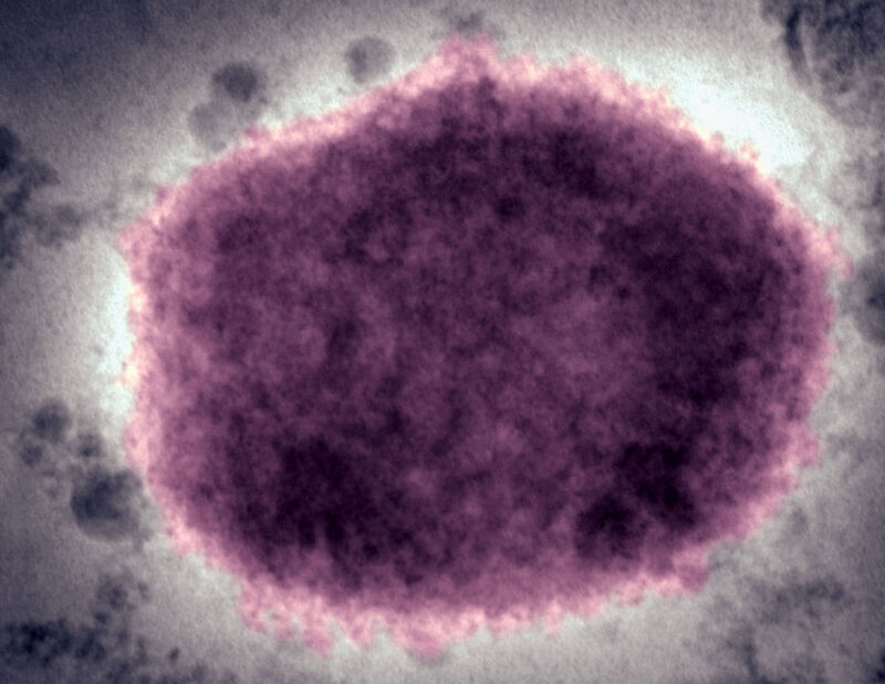 US officials monitoring over 400 people for monkeypox; 21 cases confirmed