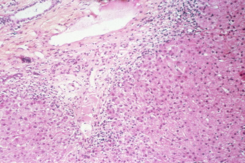 New hypothesis emerges to explain mysterious hepatitis cases in kids