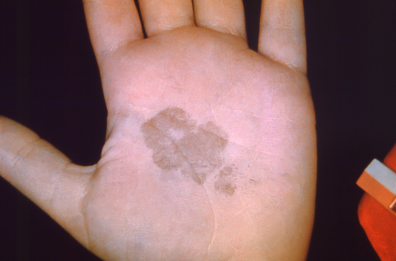 Rare tropical fungus randomly blooms in the palm of a US teen’s hand