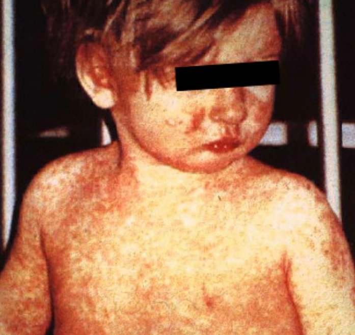 Measles outbreak erupts among unvaccinated children in Ohio daycare