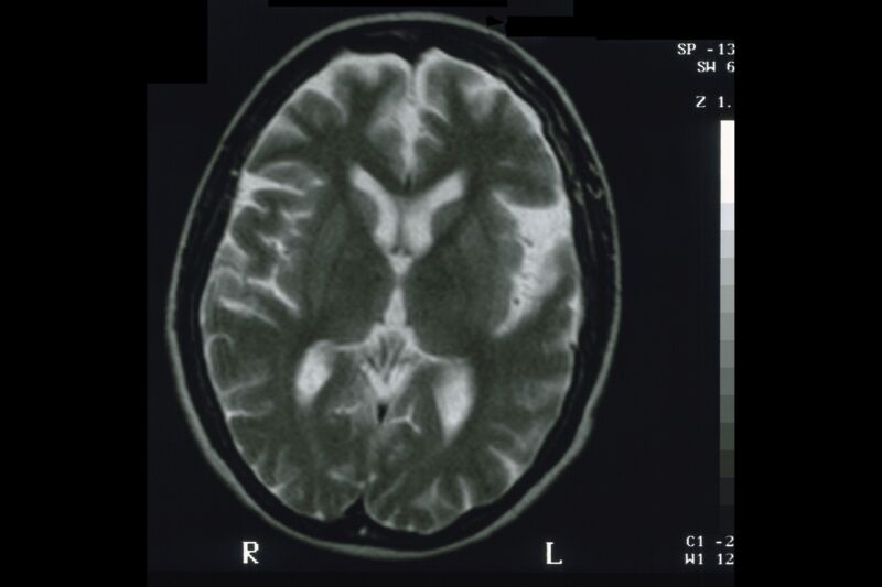 FDA approves new Alzheimer’s treatment despite risks, unclear benefits