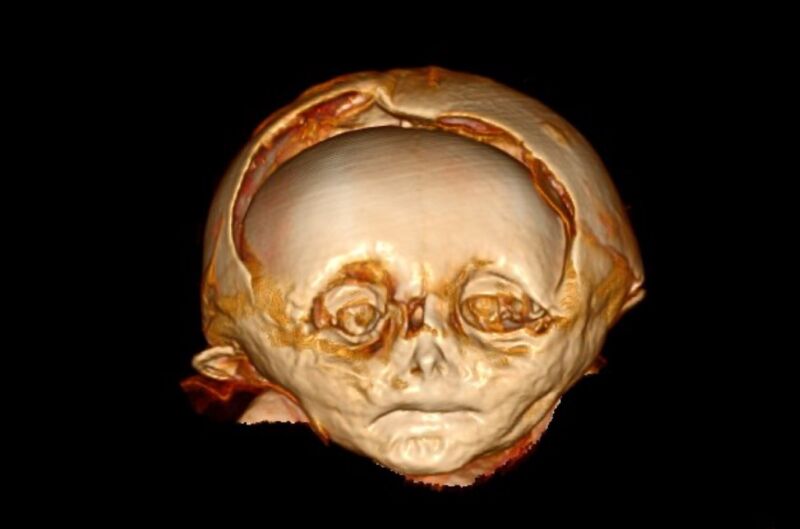 Tale from the crypt: Researchers conduct “virtual autopsy” of mummified toddler