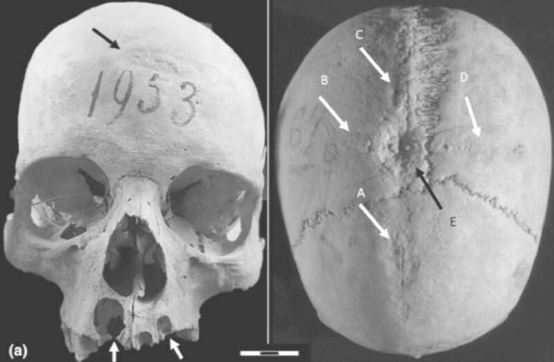 Archaeologists found evidence of trepanation on medieval woman’s skull