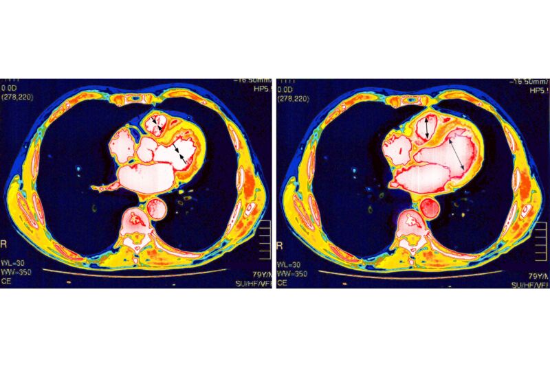 Rare myocarditis after COVID shots: Study rules out some common culprits