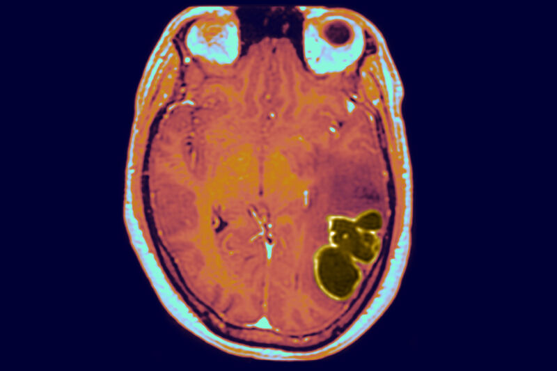 Dangerous brain abscesses spiked in US kids as COVID restrictions dropped
