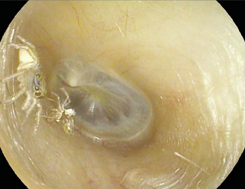 Teeny jumping spider found in woman’s ear after days of torturous racket