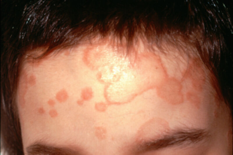 Antifungals are going the way of antibiotics—overused, hitting resistance