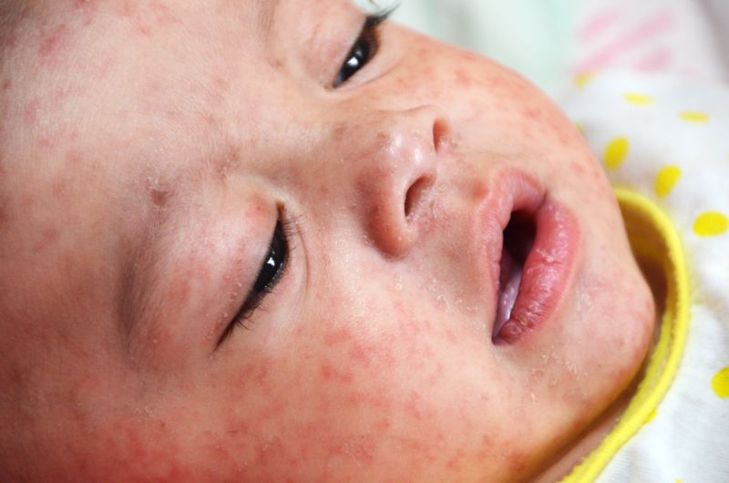 Measles is “growing global threat,” CDC tells doctors in alert message