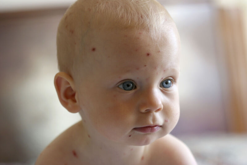 More than half of chickenpox diagnoses are wrong, study finds