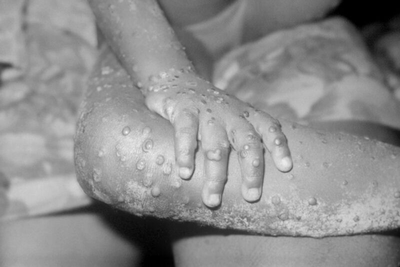 New mpox outbreak raises alarm; WHO considers declaring international emergency