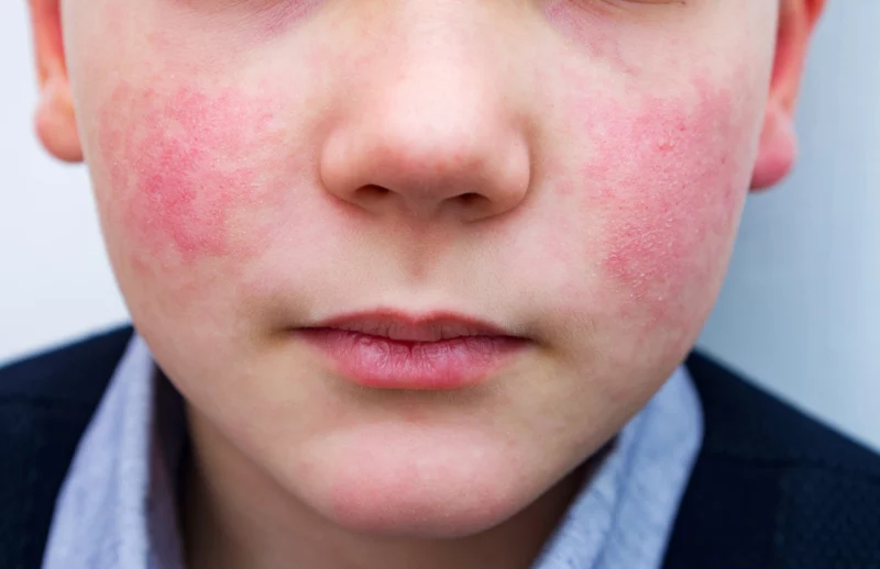 “Slapped cheek” virus is surging across Europe and US, CDC warns