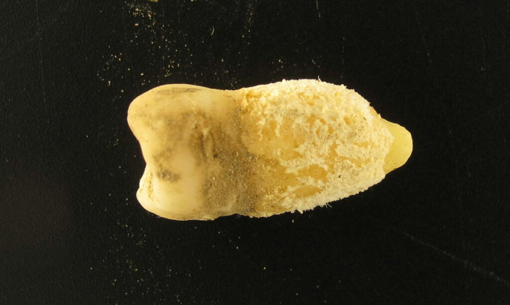 Scarlet Fever Bacterium Detected in 700-Year-Old Tooth