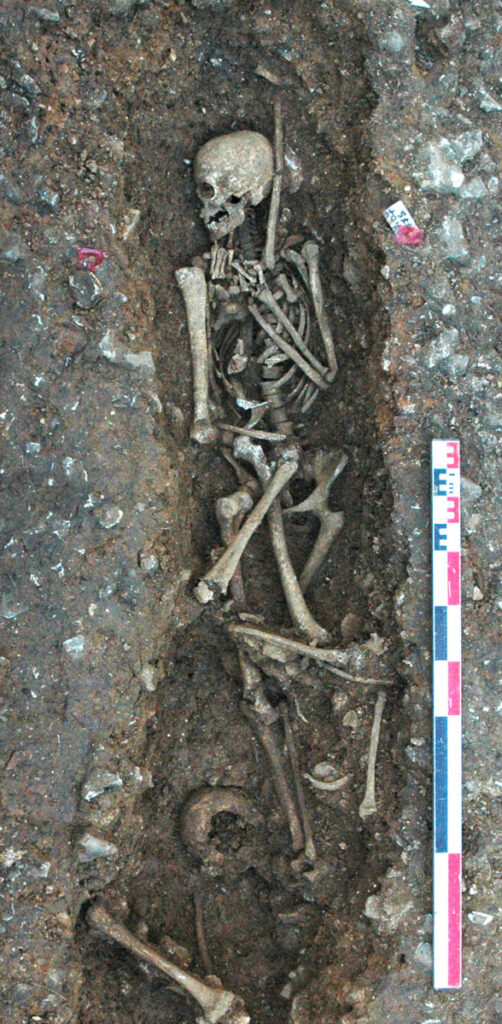Mercury Detected in Medieval Lepers’ Dental Calculus