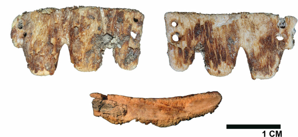 19th-Century Portuguese Dental Bridge Examined