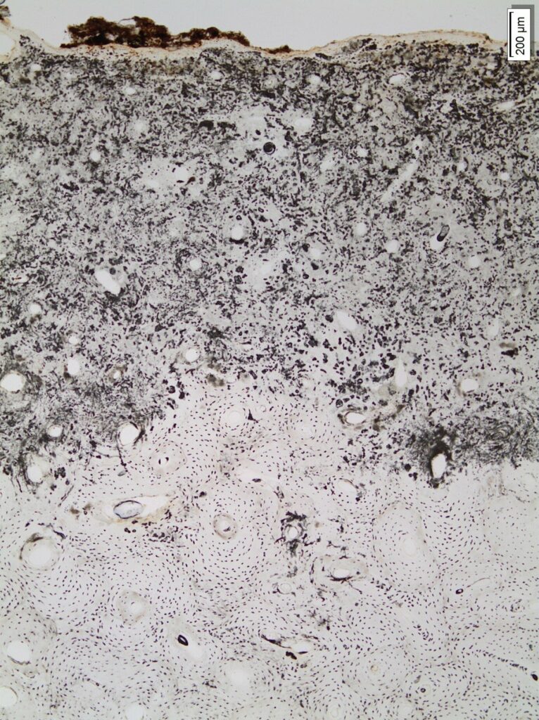 Why Do Some Bones Decay Faster Than Others?
