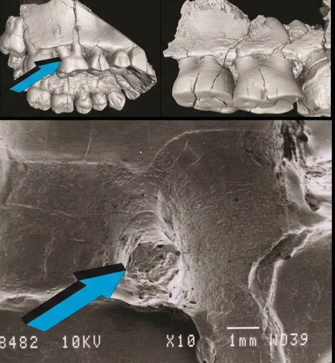 Periodontal Disease May Have Influenced Human Evolution